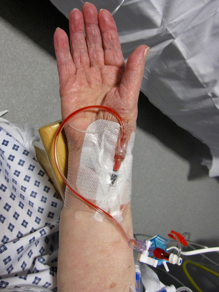 Arterial Line - RPA ICS